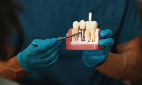 Dental Implants